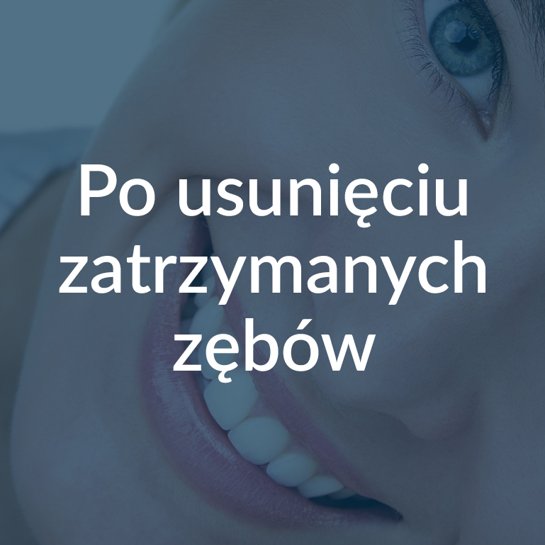 Zalecenia Po usunięciu zatrzymanych zębów Białystok